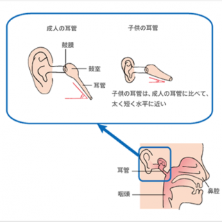 中耳炎に鼓膜切開は必要か 子どもの場合 ゆうき耳鼻科院長のblog