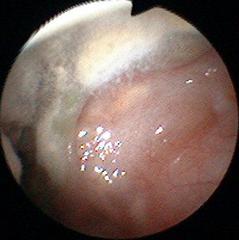 慢性中耳炎術後耳の感染：MRSA+真菌