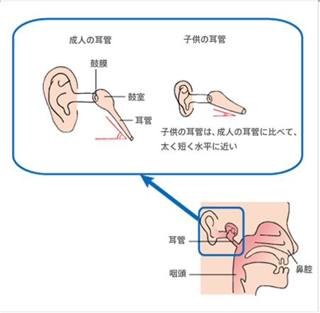 中耳炎に鼓膜切開は必要か 子どもの場合 ゆうき耳鼻科院長のblog